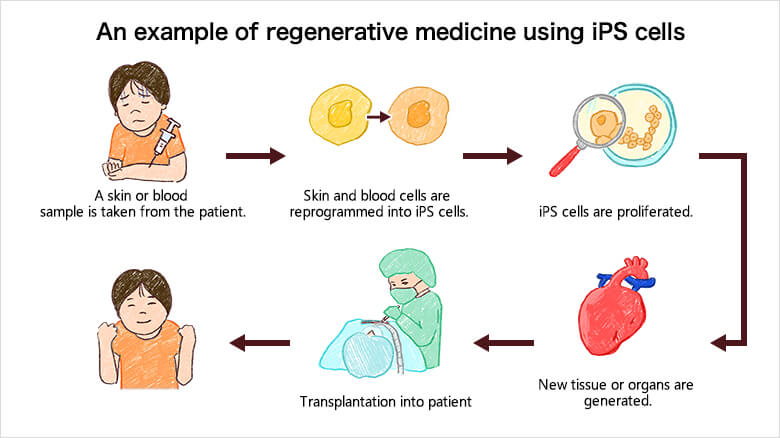 使用 iPS 细胞的再生医学示例